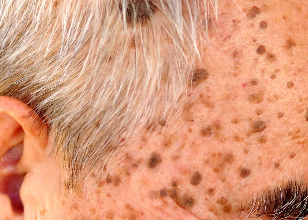 Appearance Of Seborrheic Keratosis Or Age Spots In Older Adults My
