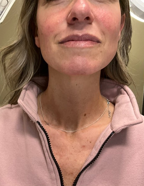 client Allison showing clear skin one month after Morpheus8 treatment