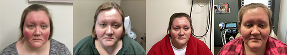 patient's gradual results from lumecca treatments for rosacea