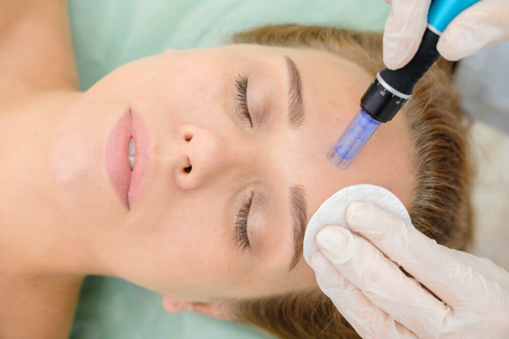 woman undergoing microneedling