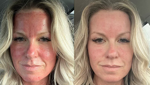 client Allison day of Morpheus8 treatment versus one day after