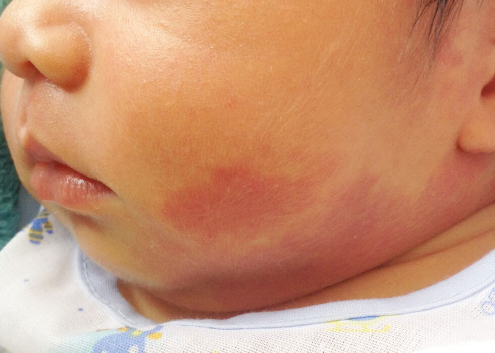 baby with a vascular birthmark on their face.