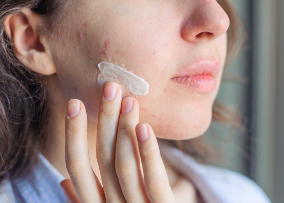 hand applying cream to acne breakout