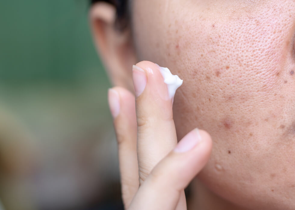 close up of hand putting cream on acne