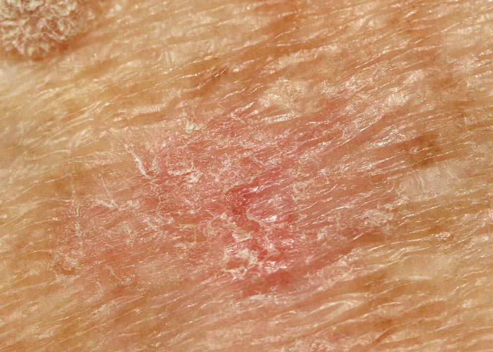 actininc keratoses skin patch