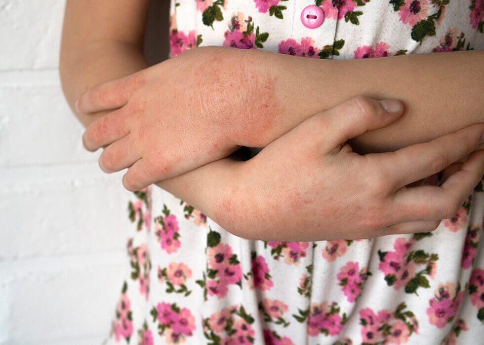 little girl scratching rash on her arms.