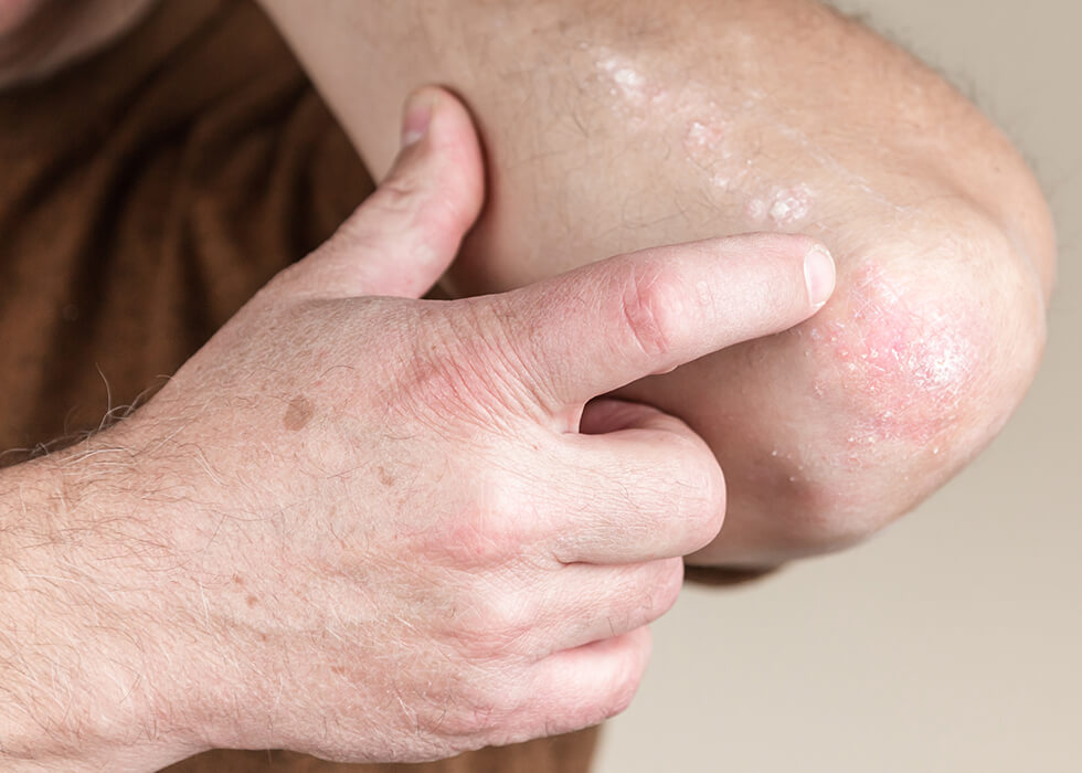 man pointing to fungal infection on elbow.