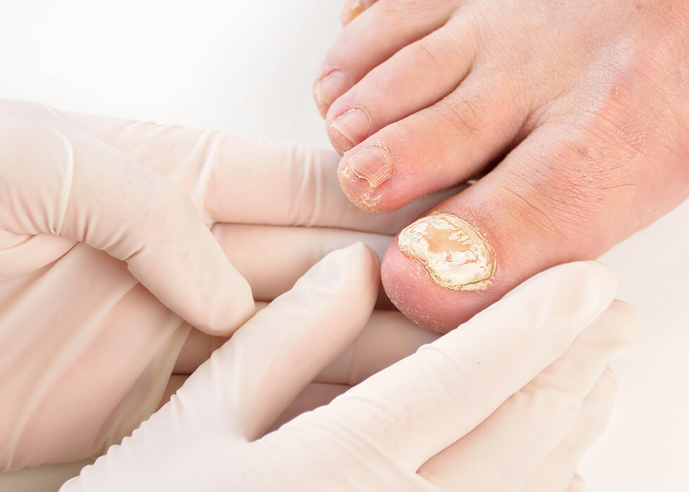 doctor treating fungal infection on foot.