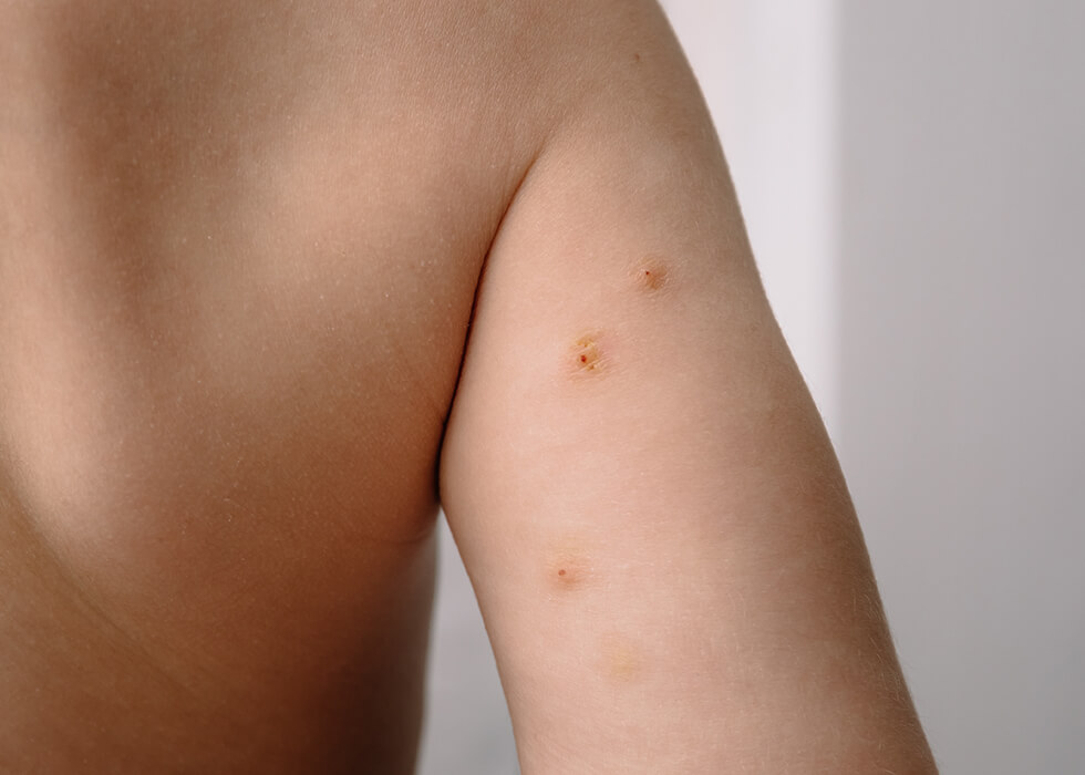 molluscum contagiosum on the back of the arm.