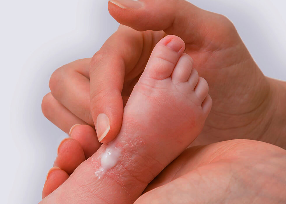 rash on baby's foot.