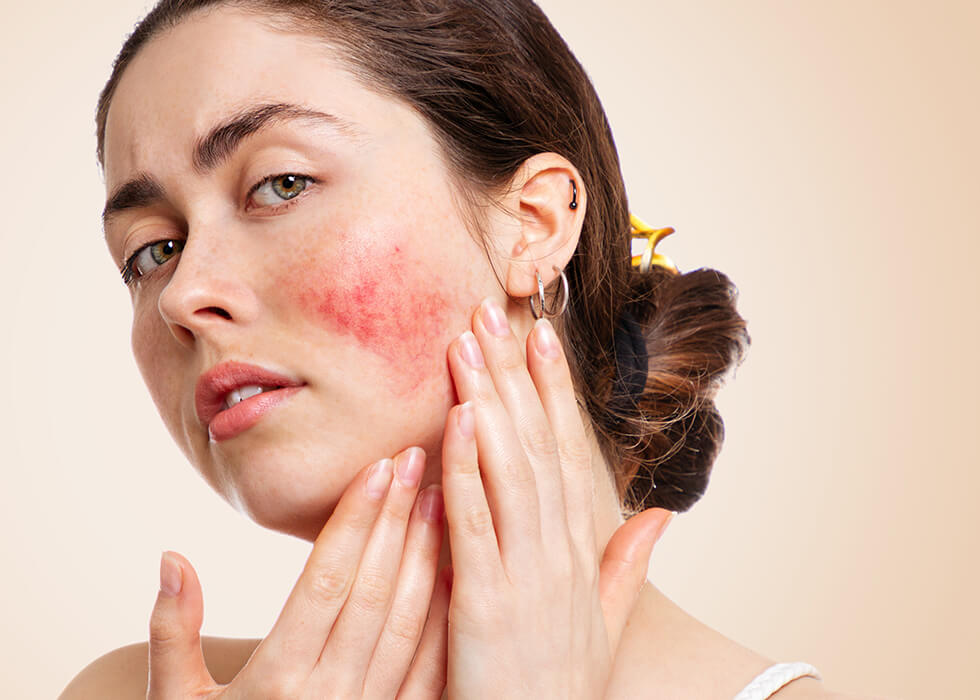 woman cupping face with rosacea breakout.