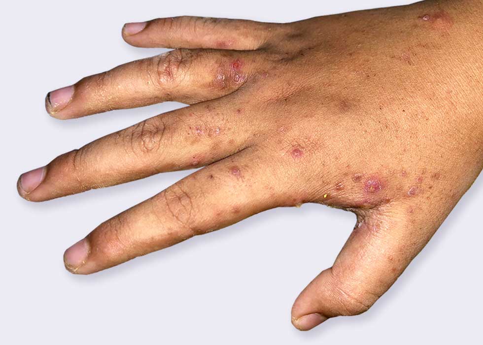 child's hand covered in scabies.