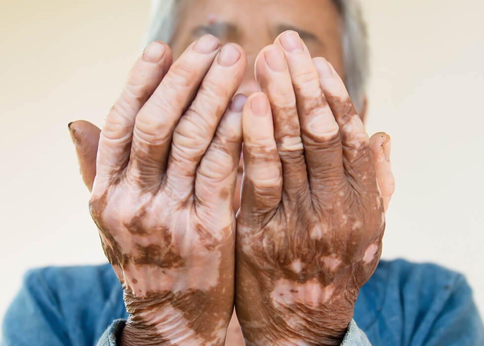 vitiligo on elderly woman's hands.