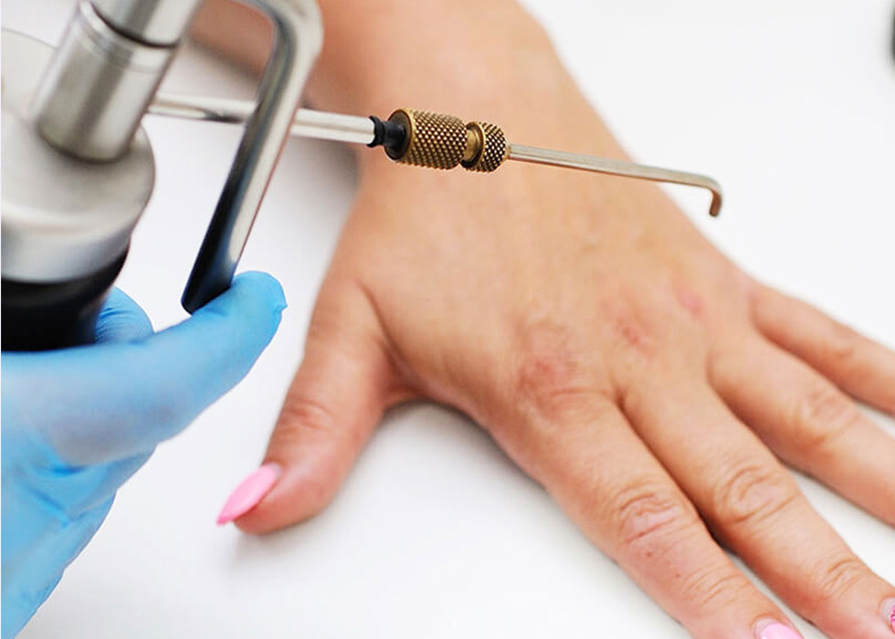 doctor treating wart with laser.