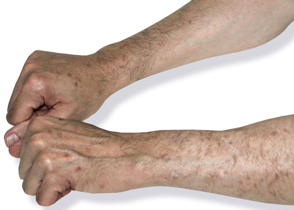 actinic keratosis on hand