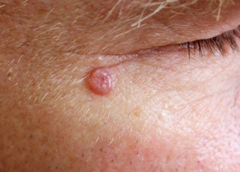 basal cell carcinoma on elderly man's cheek.