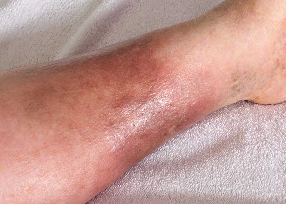 cellulitis on leg