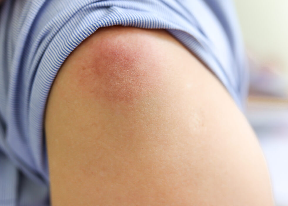 cellulitis on the shoulder