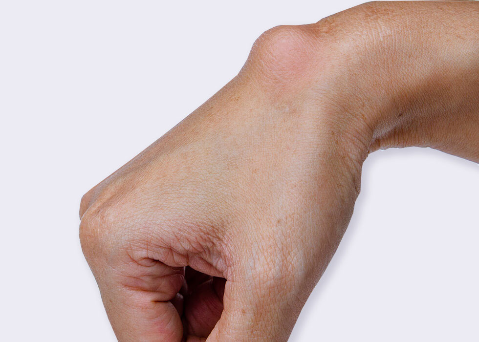 cyst on hand
