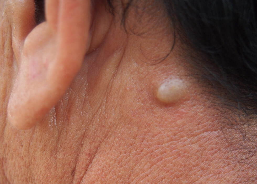 cyst on the back of the neck.