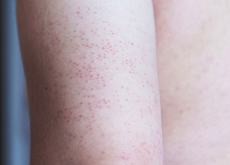 Keratosis Pilaris Causes & Treatment | Dermatology Inc.