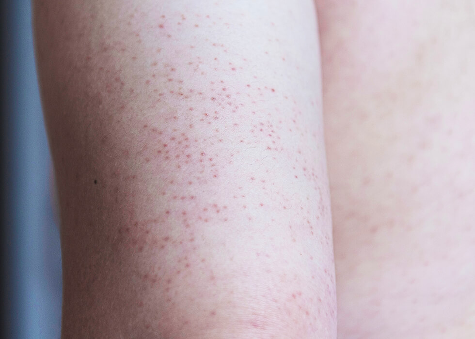 keratosis pilaris on the back of arm.