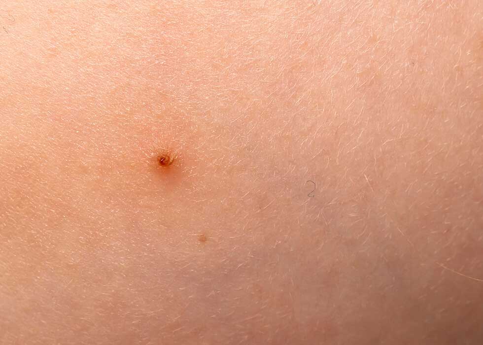 Molluscum contagiosum on child's cheek.