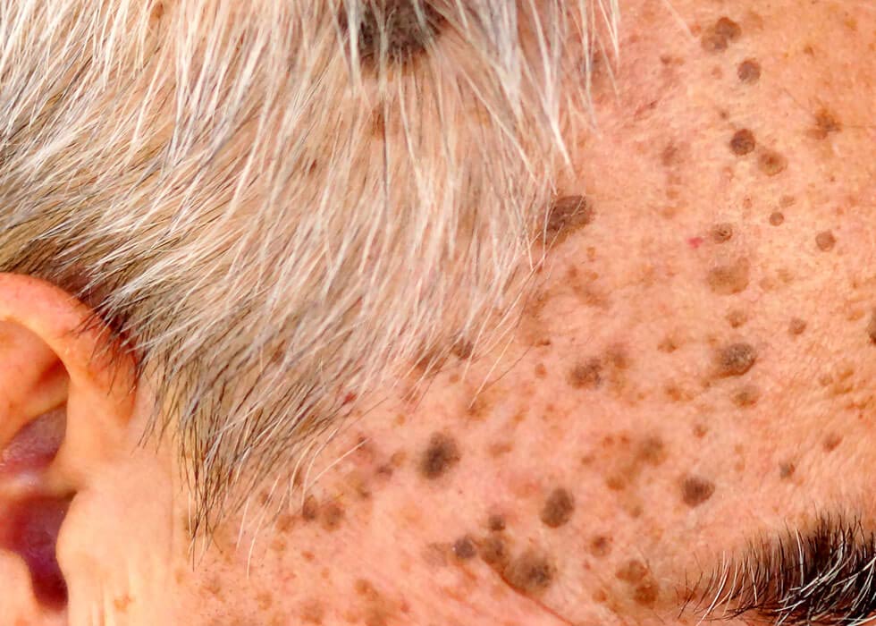 Seborrheic Keratosis Causes Treatments Dermatology Inc Seborrheic Keratosis Causes Treatments Dermatology Inc